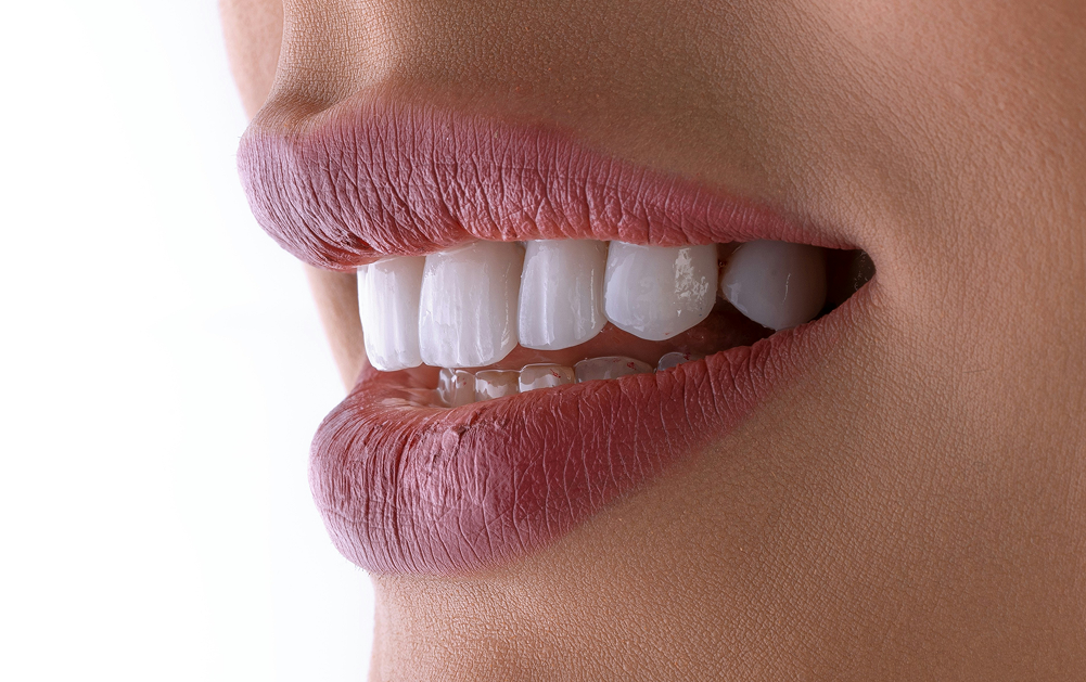 Gros plan d’un sourire montrant des dents blanches et alignées.